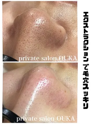 OUKA脱毛 毛穴ケアフェイシャルのエステ・リラクイメージ