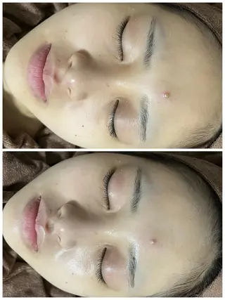 ニキビ／毛穴ケア ハーブピーリングのエステ・リラクイメージ