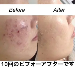 ショート カラー パーマ ヘアアレンジ キッズ ネイル マツエク・マツパ 都度払い肌質改善 &脱毛Blancheのエステ・リラクイメージ