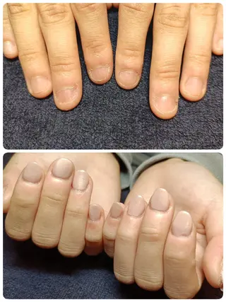 ネイル 深爪矯正/爪育成ケア manie nailのネイルデザイン