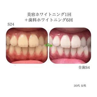 東区香椎歯のセルフホ ワイトニングGLOWのその他イメージ