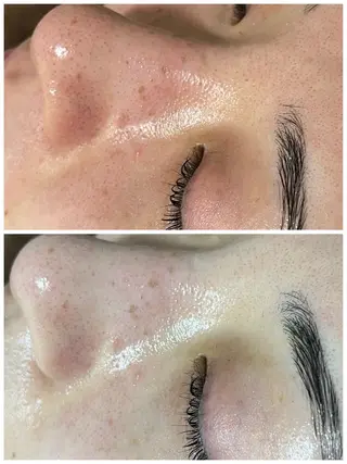 ニキビ／毛穴ケア ハーブピーリングのエステ・リラクイメージ