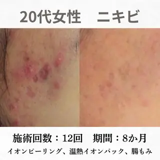重度ニキビ専門🌷 ダウンタイムなしのエステ・リラクイメージ