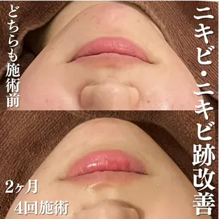 3か月で肌革命👼 ニキビ専門店💫のエステ・リラクイメージ