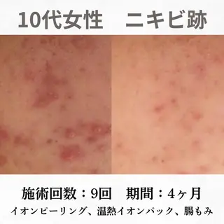 重度ニキビ専門🌷 ダウンタイムなしのエステ・リラクイメージ