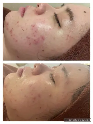 ロング カラー パーマ ヘアアレンジ メンズ キッズ ネイル マツエク・マツパ アイブロウ 3か月で肌革命👼 ニキビ専門店💫のエステ・リラクイメージ