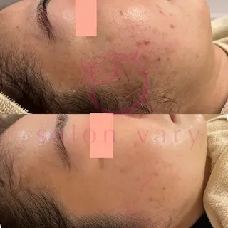 【ニキビ/肌管理】 salon varyのエステ・リラクイメージ
