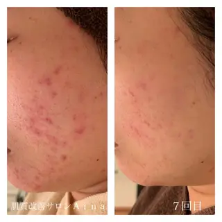 ミディアム カラー パーマ ヘアアレンジ メンズ キッズ ネイル マツエク・マツパ ニキビ跡専門サロン Ainaのエステ・リラクイメージ