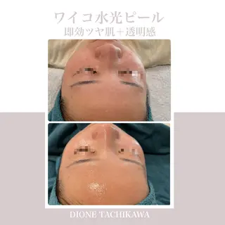 【リベルハーブピーリング認定店】敏感肌・美白脱毛専門店Dione立川店所属・Dione 立川店のエステ・リラクイメージ