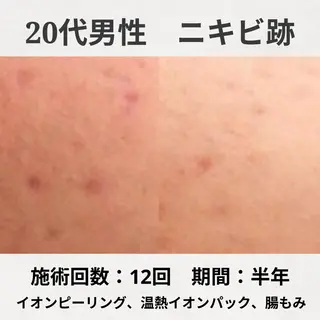 ニキビ特化型エステ 🍋最短で肌質改善のエステ・リラクイメージ