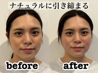 肌質改善×美容鍼 ゆいのエステ・リラクイメージ