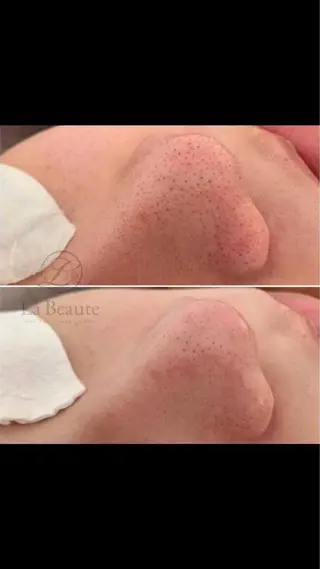 最速 毛穴シミ改善 いくえのその他イメージ