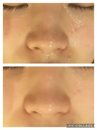 ロング カラー パーマ ヘアアレンジ メンズ キッズ ネイル マツエク・マツパ アイブロウ 3か月で肌革命👼 ニキビ専門店💫のエステ・リラクイメージ