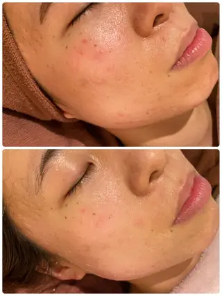 ショート カラー パーマ ヘアアレンジ メンズ キッズ ネイル マツエク・マツパ アイブロウ 3か月で肌革命👼 ニキビ専門店💫のエステ・リラクイメージ