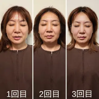 即効⚡小顔美容鍼🪡 むくみたるみ脂肪解消のエステ・リラクイメージ