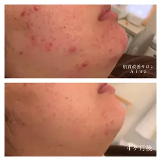 セミロング カラー パーマ ヘアアレンジ キッズ ネイル マツエク・マツパ ニキビ跡専門サロン Ainaのエステ・リラクイメージ