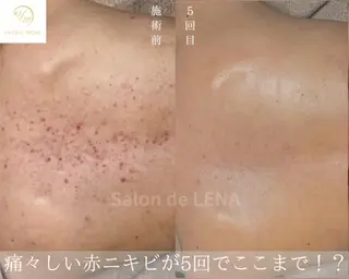 ハーブピーリング・毛穴ケア専門サロンSalon de LENA 栄店所属・ハーブピーリング専門 サロンドレナ　白藤のエステ・リラクイメージ