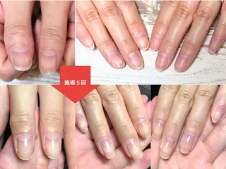 ネイル 深爪矯正・自爪育成 ネイルサロンアモまいのネイルデザイン