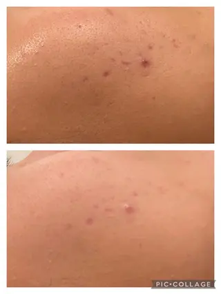 セミロング カラー パーマ ヘアアレンジ キッズ ネイル マツエク・マツパ アイブロウ 3か月で肌革命👼 ニキビ専門店💫のエステ・リラクイメージ