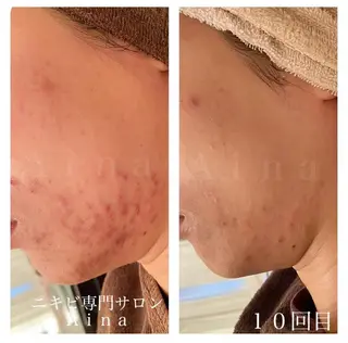 セミロング カラー パーマ ヘアアレンジ メンズ キッズ ネイル マツエク・マツパ ニキビ跡専門サロン Ainaのエステ・リラクイメージ