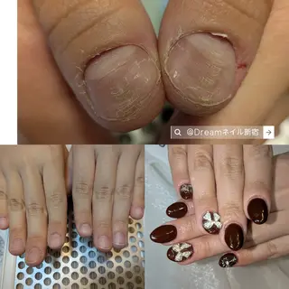 ネイル フィルイン・深爪矯正 長さ出し🎀のネイルデザイン