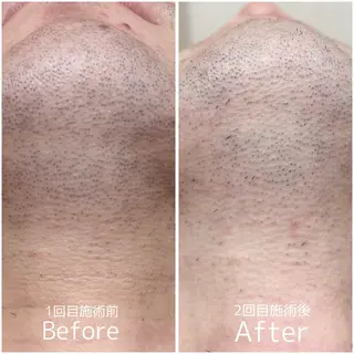 脱毛・ホワイトニング 耳ツボ・美白・毛穴のその他イメージ