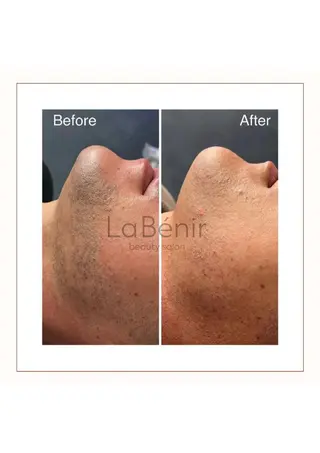 メンズ 脱毛/美肌【皮膚科看 護師経営】ラベニールのエステ・リラクイメージ