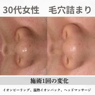 重度ニキビ専門🌷 ダウンタイムなしのエステ・リラクイメージ