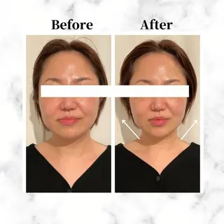 12Dハイフ💗 最強小顔のエステ・リラクイメージ