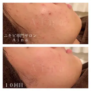 セミロング パーマ ヘアアレンジ メンズ キッズ ネイル マツエク・マツパ アイブロウ ニキビ跡専門サロン Ainaのエステ・リラクイメージ