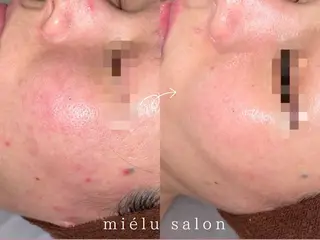 小顔矯正|痩身 miélusalonのエステ・リラクイメージ
