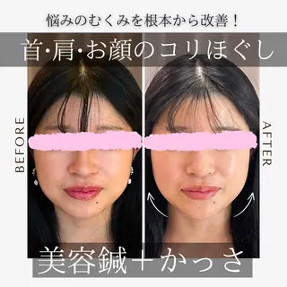 《美肌･小顔》美容鍼 ＆マッサージ＊MEIのエステ・リラクイメージ