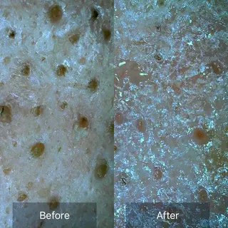 ielu〜毛穴ケア ハーブピーリングのエステ・リラクイメージ