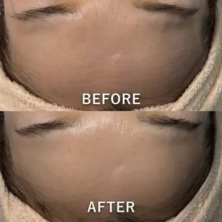 【ハーブピーリング】 Allumentのエステ・リラクイメージ