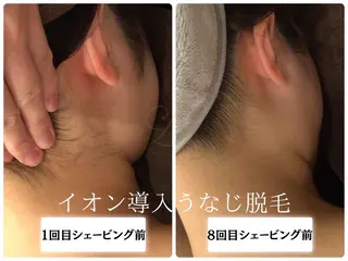 🎀うなじ脱毛🎀 ㅣLino堀江のエステ・リラクイメージ