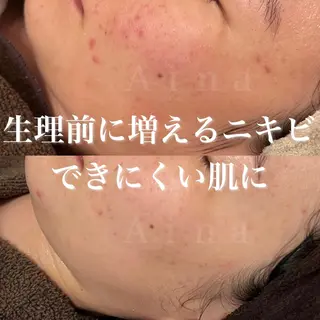 セミロング パーマ ヘアアレンジ メンズ キッズ ネイル マツエク・マツパ アイブロウ ニキビ跡専門サロン Ainaのエステ・リラクイメージ