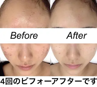 セミロング カラー パーマ ヘアアレンジ キッズ ネイル マツエク・マツパ 都度払い肌質改善 &脱毛Blancheのエステ・リラクイメージ