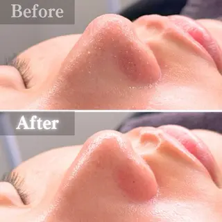 毛穴洗浄特化🫧 オオツカのエステ・リラクイメージ