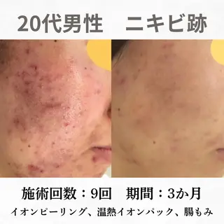 重度ニキビ専門🌷 ダウンタイムなしのエステ・リラクイメージ