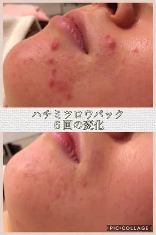 ニキビ・肌質改善専門 ♡人生が変わるサロンのエステ・リラクイメージ