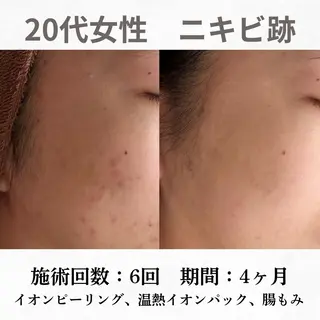 重度ニキビ専門🌷 ダウンタイムなしのエステ・リラクイメージ