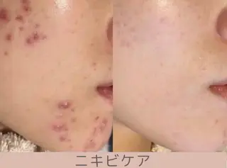 小顔/毛穴/ニキビ salon bealのエステ・リラクイメージ