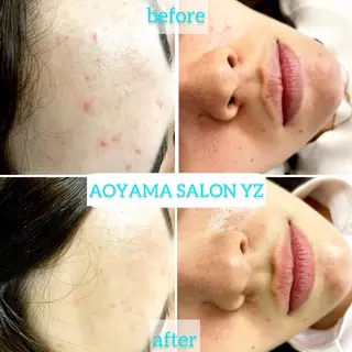 渋谷 小顔美容鍼 専門サロン YZのエステ・リラクイメージ
