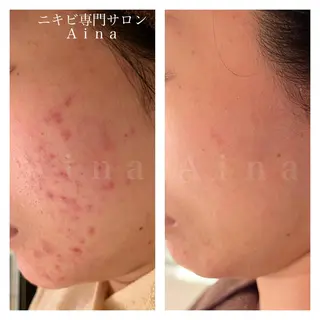 セミロング パーマ ヘアアレンジ メンズ キッズ ネイル マツエク・マツパ アイブロウ ニキビ跡専門サロン Ainaのエステ・リラクイメージ