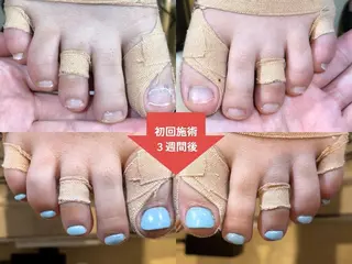 ネイル 深爪矯正・自爪育成 ネイルサロンアモまいのネイルデザイン