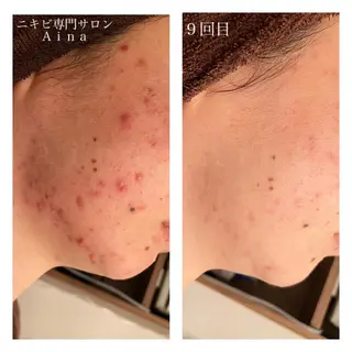 セミロング カラー パーマ ヘアアレンジ メンズ キッズ ネイル マツエク・マツパ ニキビ跡専門サロン Ainaのエステ・リラクイメージ
