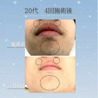 💠the4💠【脱毛特化サロン】所属・LED脱毛サロン 💐ayaのエステ・リラクイメージ