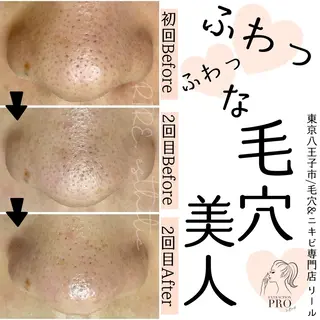 毛穴特化エステ -リールのエステ・リラクイメージ