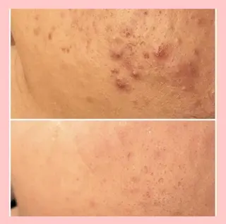 セミロング カラー パーマ ヘアアレンジ メンズ キッズ ネイル マツエク・マツパ アイブロウ 3か月で肌革命👼 ニキビ専門店💫のエステ・リラクイメージ