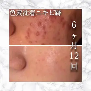 3か月で肌革命👼 ニキビ専門店💫のエステ・リラクイメージ